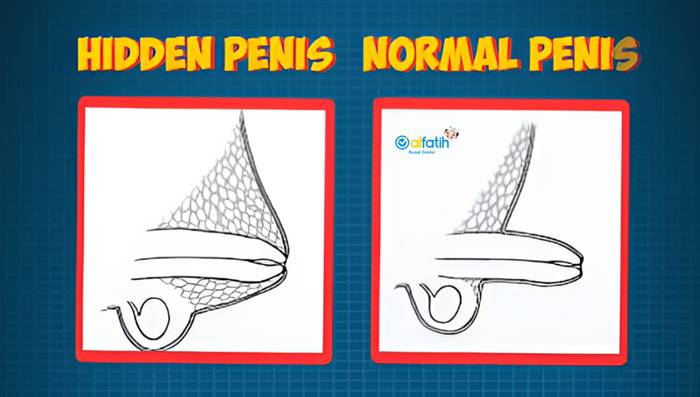 Kondisi Penis Tersembunyi pada Anak Gemuk