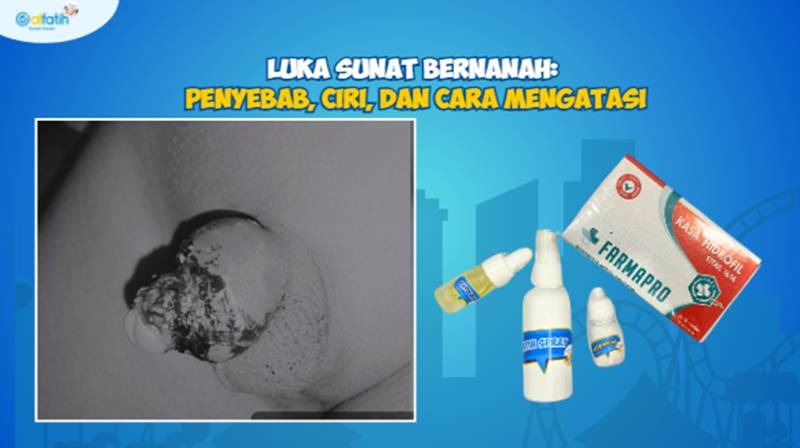Luka Sunat Bernanah: Penyebab, Ciri, dan Cara Mengatasi 1 Luka Sunat Bernanah Penyebab, Ciri, dan Cara Mengatasi