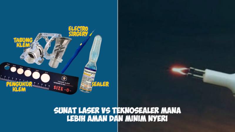 Sunat Laser vs Teknosealer Mana Lebih Aman dan Minim Nyeri