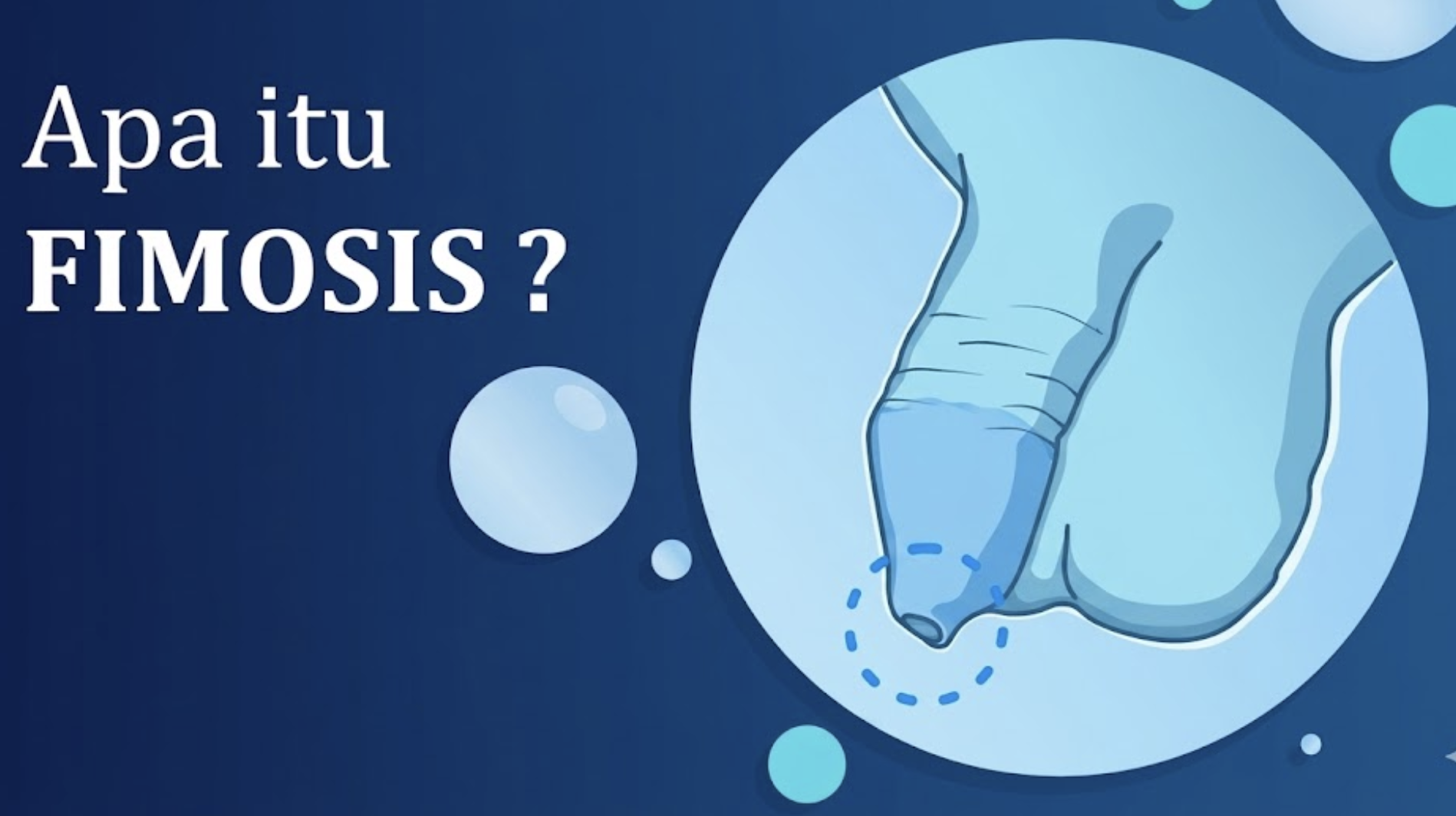 Apa Itu Fimosis? Gejala, Penyebab dan Pengobatannya
