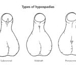gambar Hipospadia pada Bayi