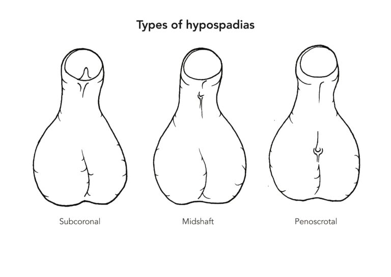 gambar Hipospadia pada Bayi