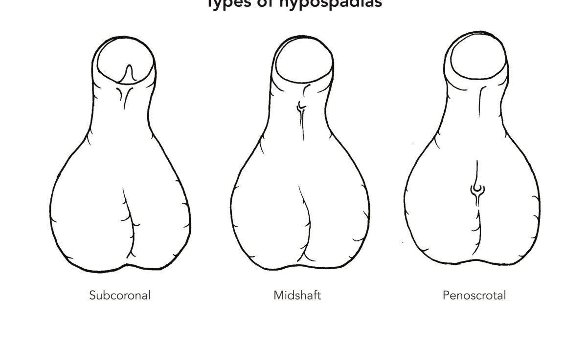 gambar Hipospadia pada Bayi